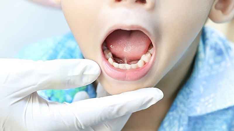 Bé bị dính thắng lưỡi không cắt có sao không?