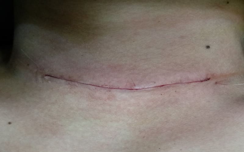 mổ tuyến giáp bao lâu thì quan hệ được