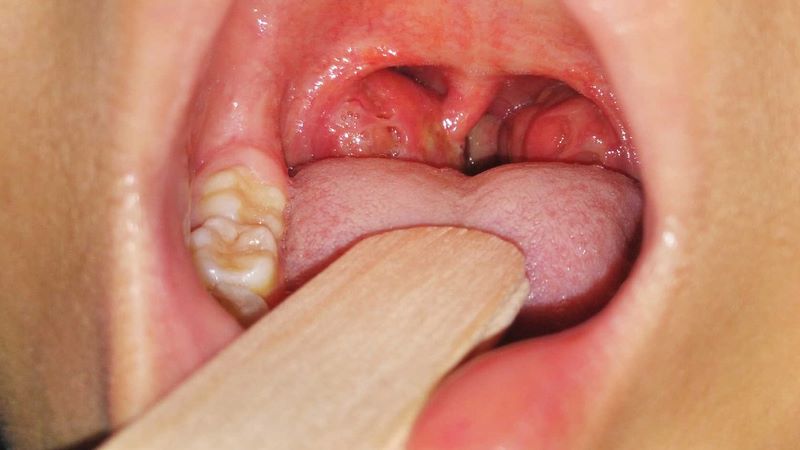 Nạo VA và cắt amidan khác nhau như thế nào?