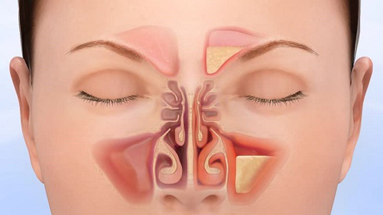 Viêm xoang mạn tính có gây ung thư không?