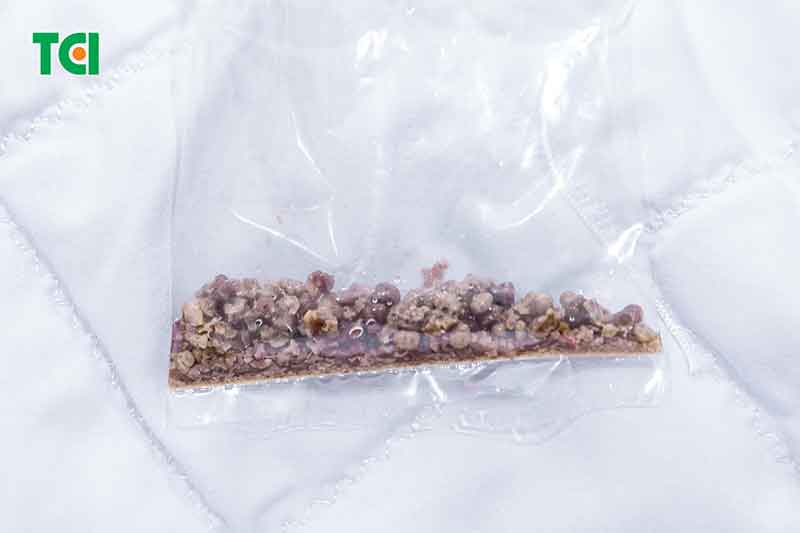 Kích thước sỏi 29mm có cần mổ không?