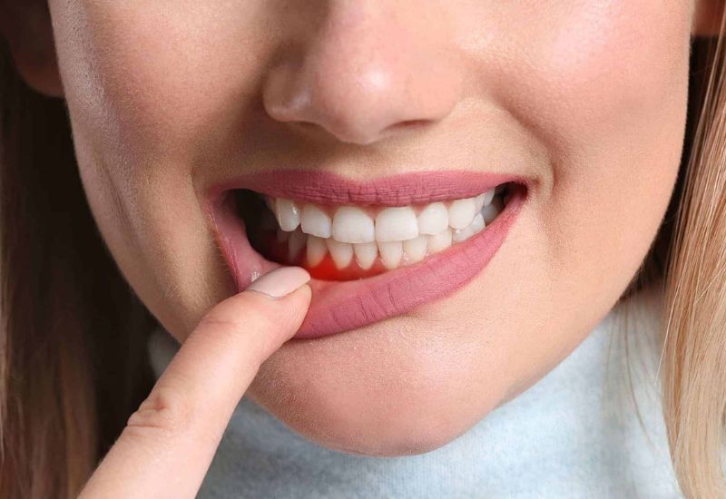 bà bầu có nên đi tẩy trắng răng không