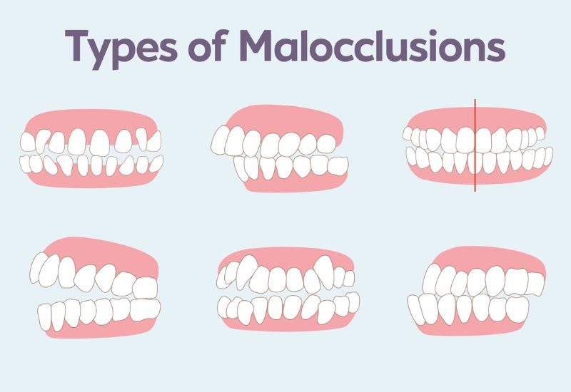 dán răng sứ veneer có tác hại gì không