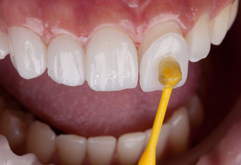 dán sứ veneer có bền không