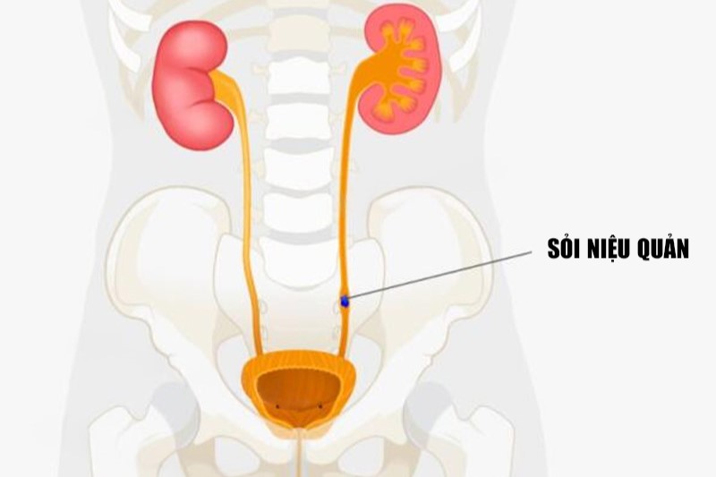 sỏi niệu quản 6mm