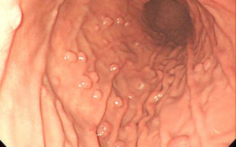 cắt polyp dạ dày có phải nằm viện không