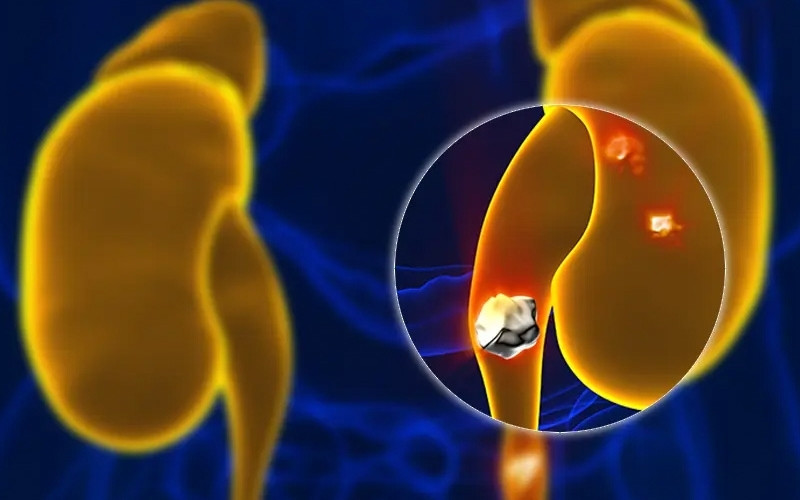 Sỏi niệu quản ⅓ trên