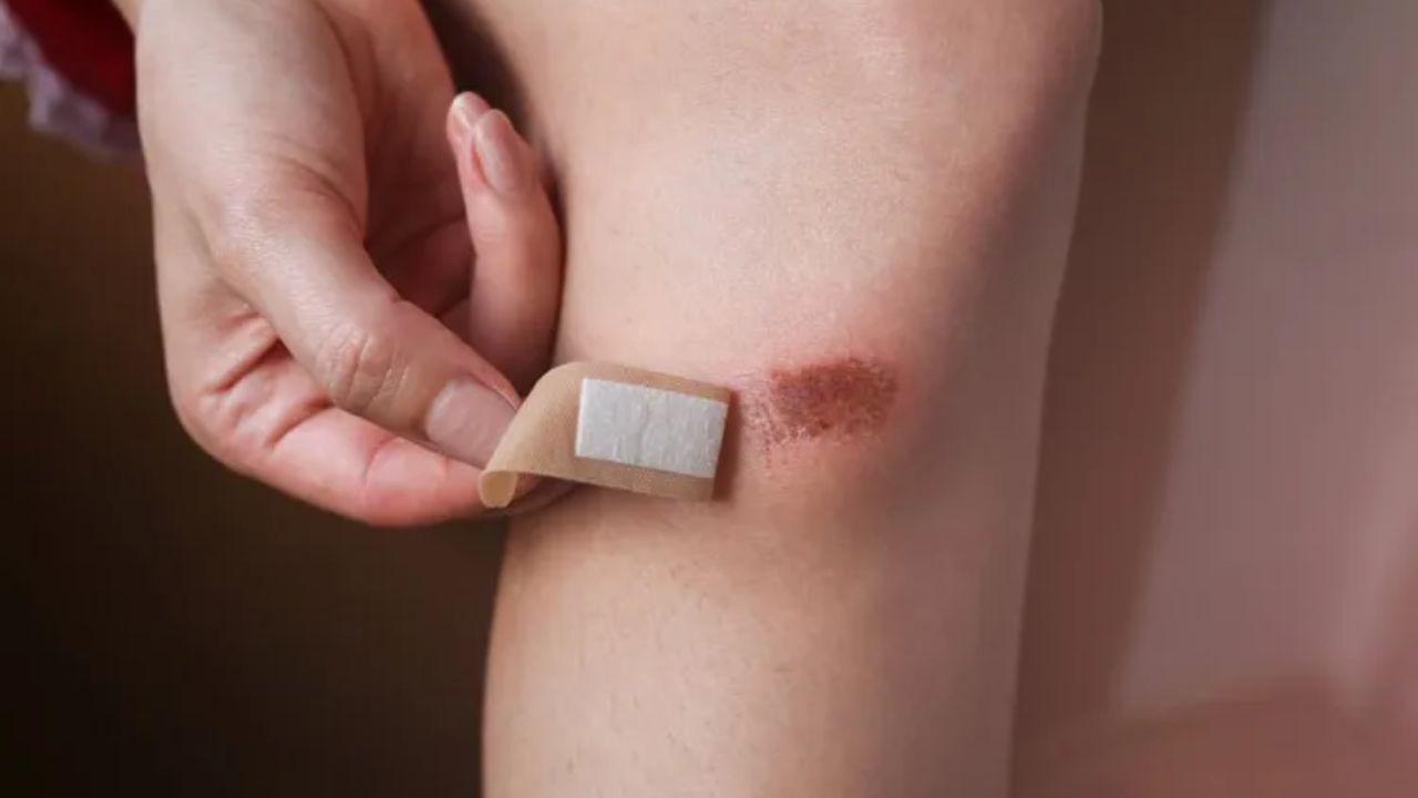 Người bị rách da nên làm gì? Hướng dẫn đầy đủ từ A đến Z