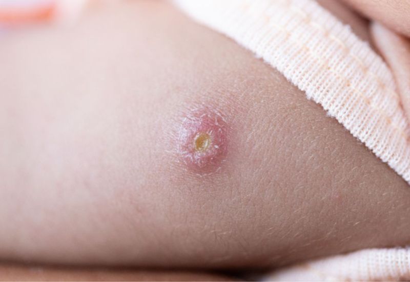 áp xe sau tiêm vaccine