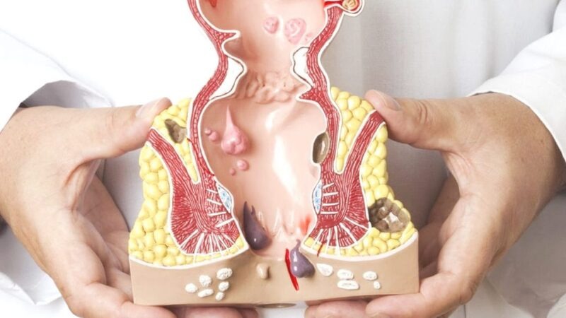 hẹp hậu môn phải làm sao