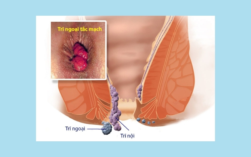 phì đại nhú gai hậu môn là gì