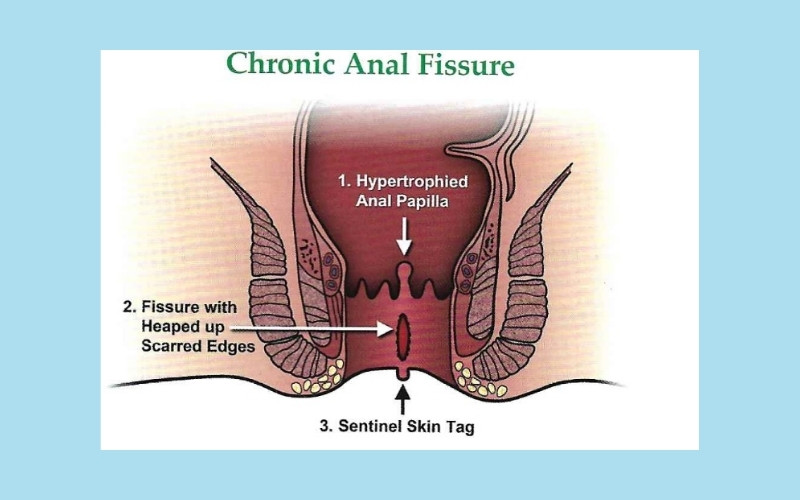 phì đại nhú gai hậu môn là gì