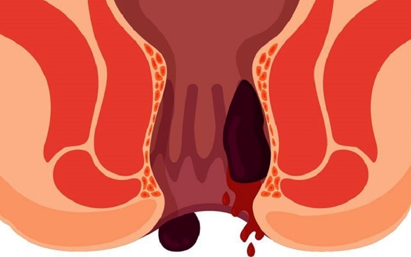 hậu môn ra máu tươi là bệnh gì