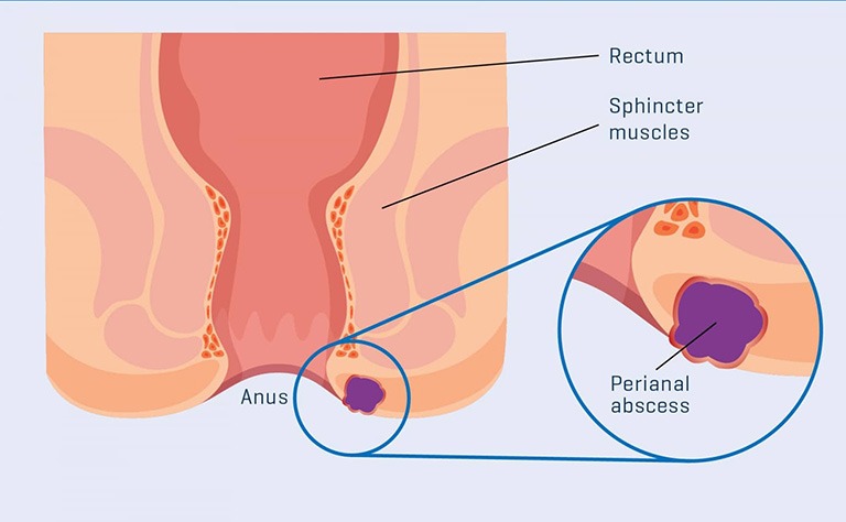 áp xe hậu môn tái đi tái lại