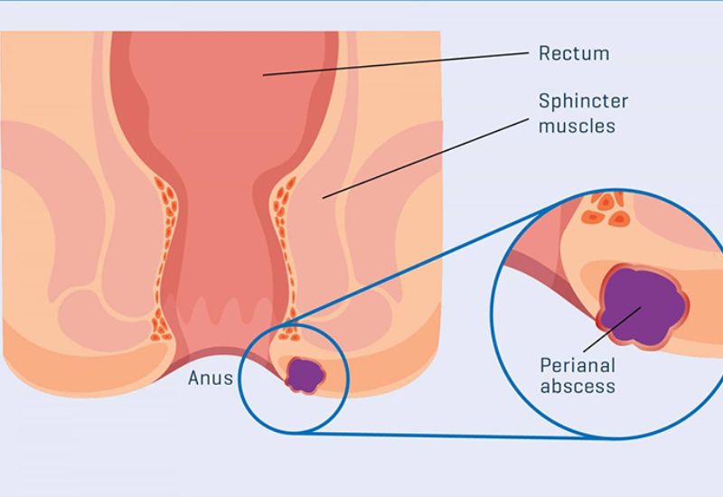áp xe hậu môn có tự hết không