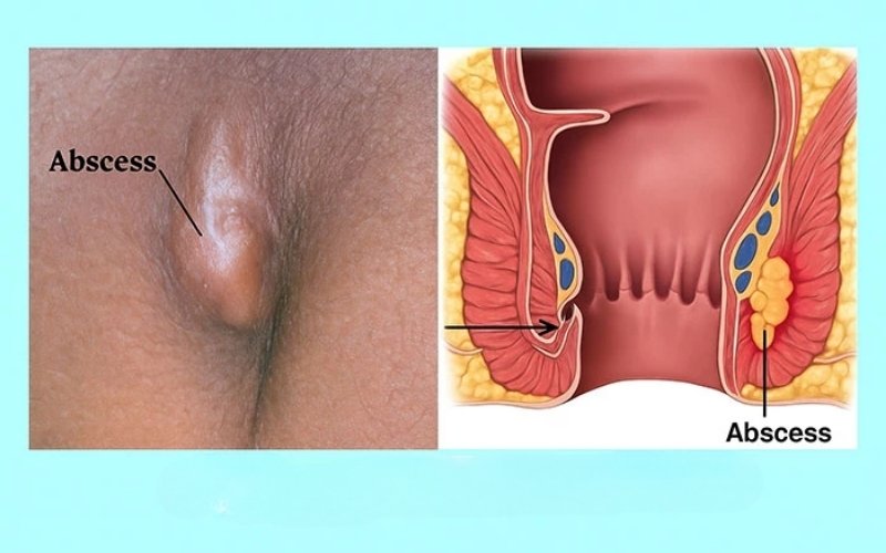cách làm giảm đau áp xe hậu môn