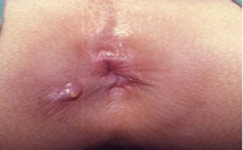 nguyên nhân áp xe hậu môn ở trẻ sơ sinh