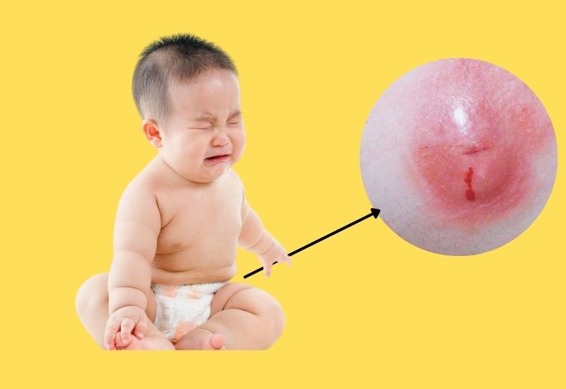 cách chữa áp xe hậu môn ở trẻ sơ sinh