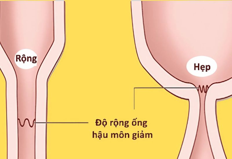dấu hiệu hẹp hậu môn sau mổ trĩ