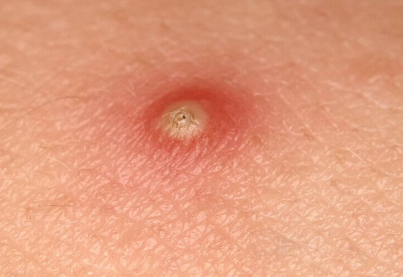 mọc mụn ở hậu môn