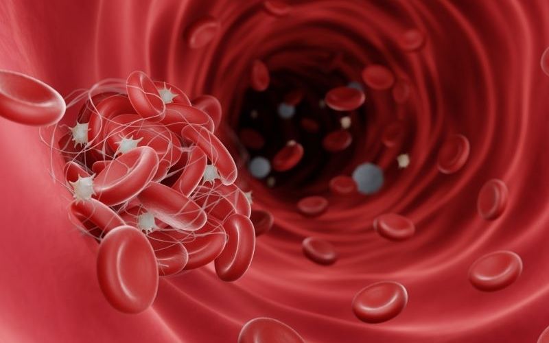 chọc hút áp xe thành bụng