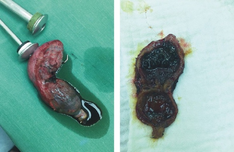 túi mật 2 ngăn có sao không