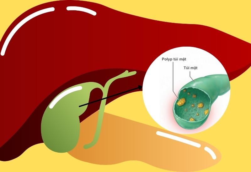 polyp túi mật có tự hết không