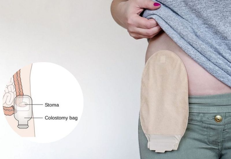 quy trình đóng hậu môn nhân tạo