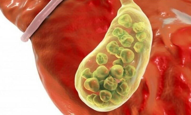 viêm túi mật cấp