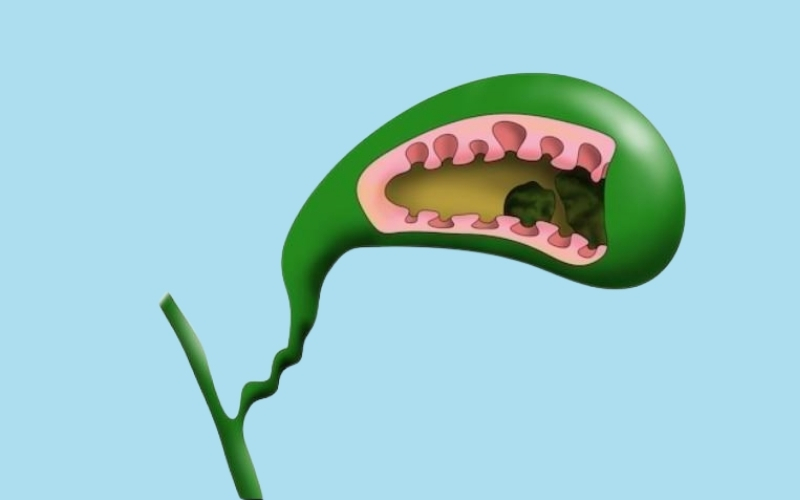 u cơ tuyến túi mật siêu âm