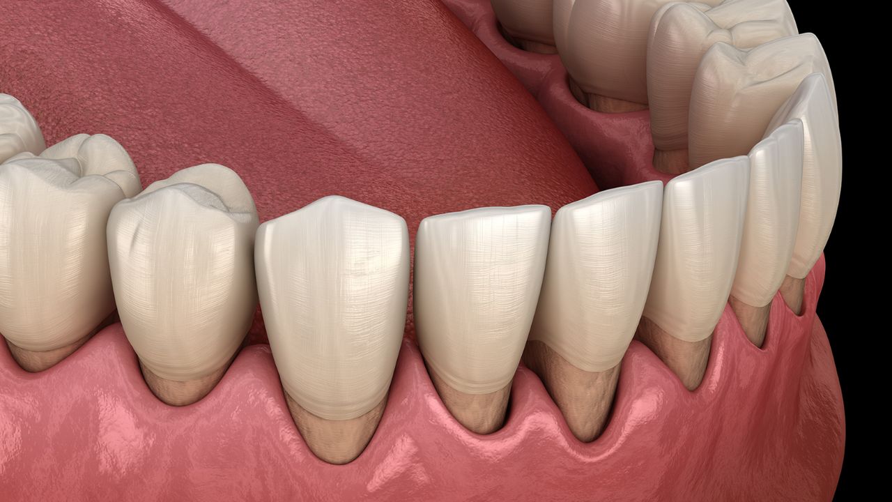 Tụt chân răng là gì? Tụt chân răng phải làm sao?
