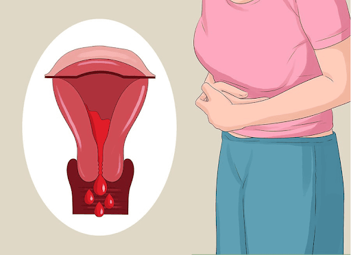 Quan hệ mạnh hoặc thiếu chất bôi trơn sau kỳ kinh có thể gây tổn thương nhẹ và chảy máu sau quan hệ.