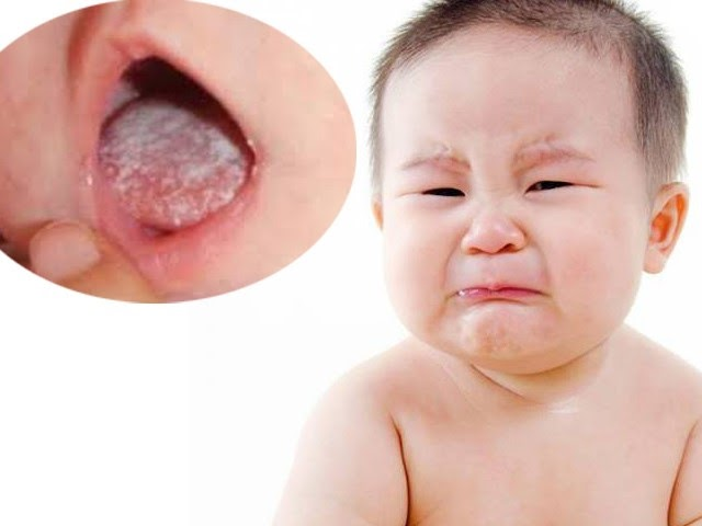 Nấm miệng nặng hoặc điều trị chưa dứt điểm có thể kéo dài 2 tuần đến 1 tháng hoặc lâu hơn, cần được bác sĩ thăm khám.